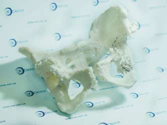 3D printed hip bone prosthesis for medical and anatomical purposes by 3DDevice.
