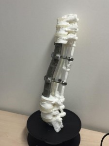 3D-печатный спинной имплантат3