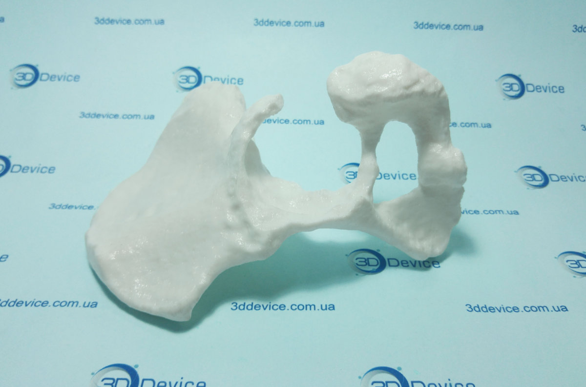 3D печать костей на основе данных КТ-сканирования