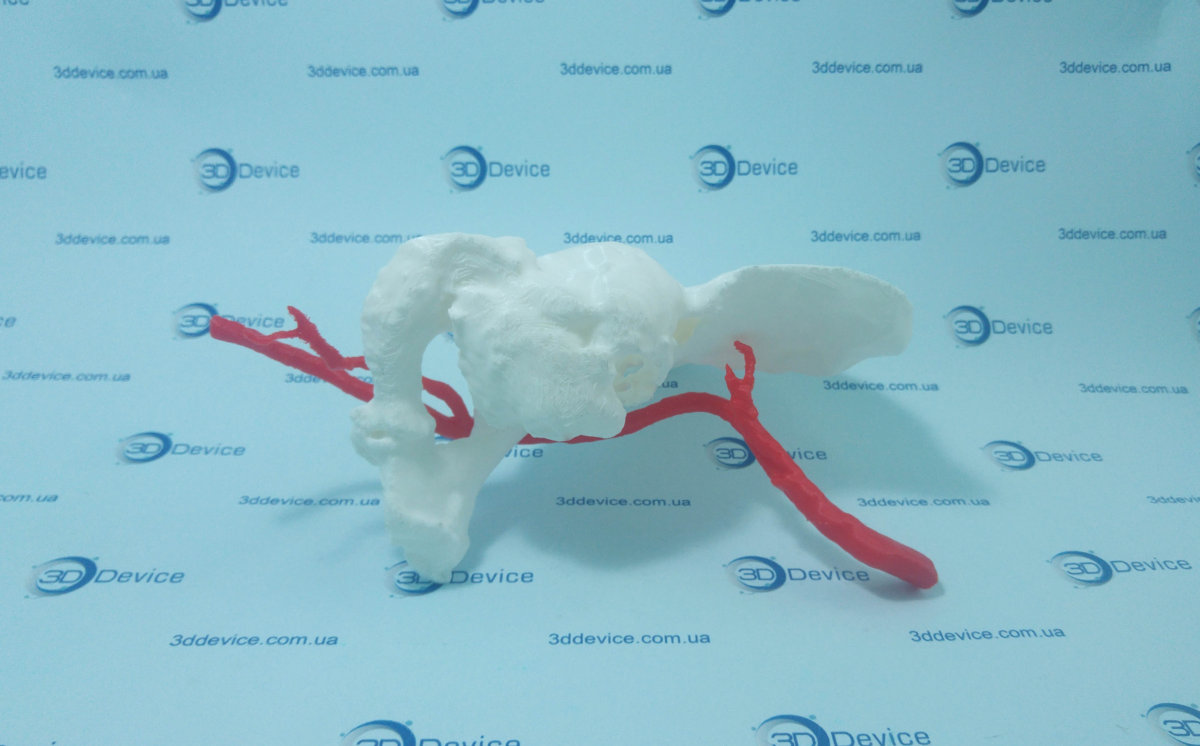3D макетирование в медицине
