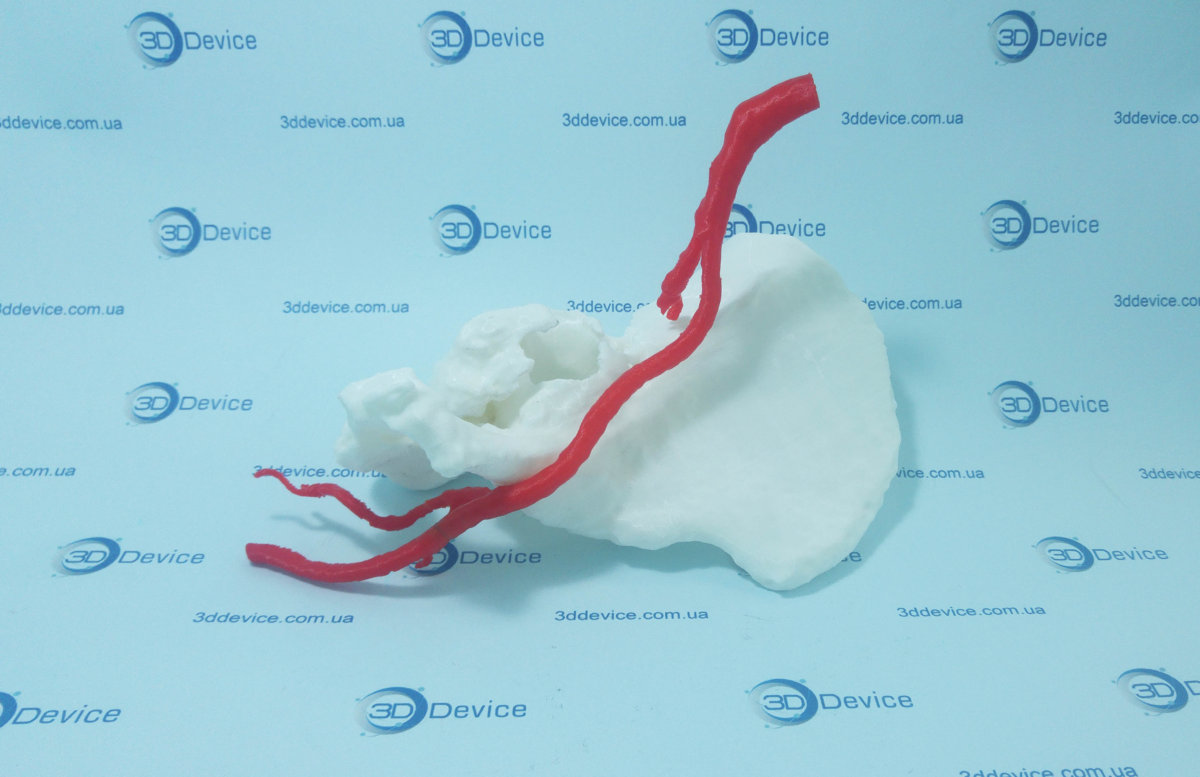 3D печать медицинская