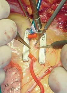 Операции на сердце и 3Д хирургия