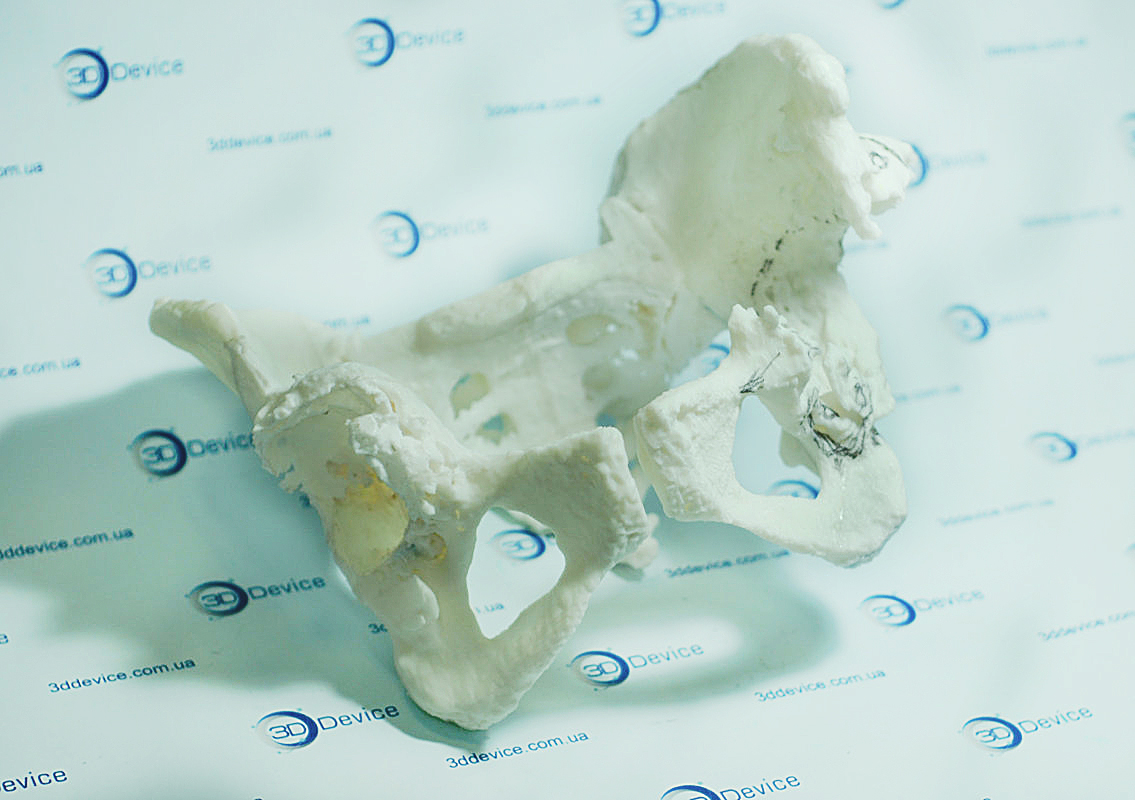 3Д-печать тазобедренной кости
