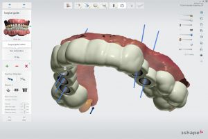 Formlabs Surgical Guide Resin зубной имплант